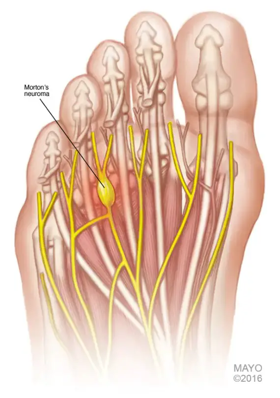Morton's Neuroma